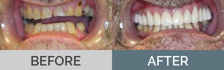 Dental Crowns & Veneers Before & After
