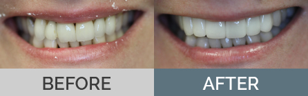 Dental Crowns, Veneers & Bridge Before & After