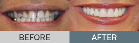 Porcelain Veneers & Dental Bridge Before & After