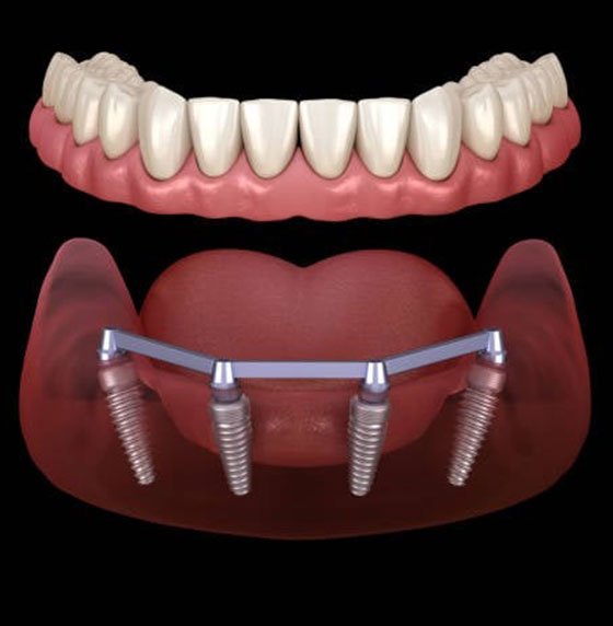 The All-On-4® Technique