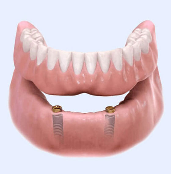 Fixed vs. Removable Solutions