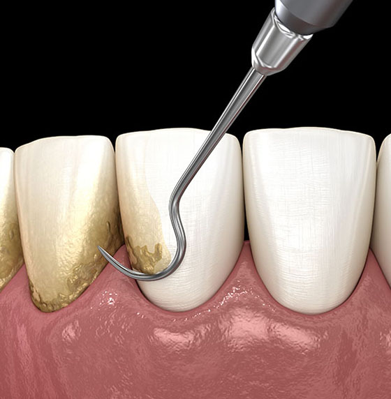 Periodontal Disease Treatment