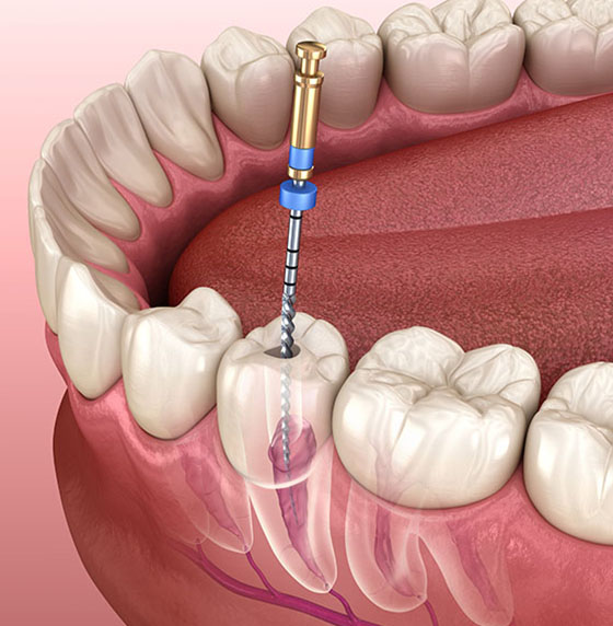 Root Canal Therapy