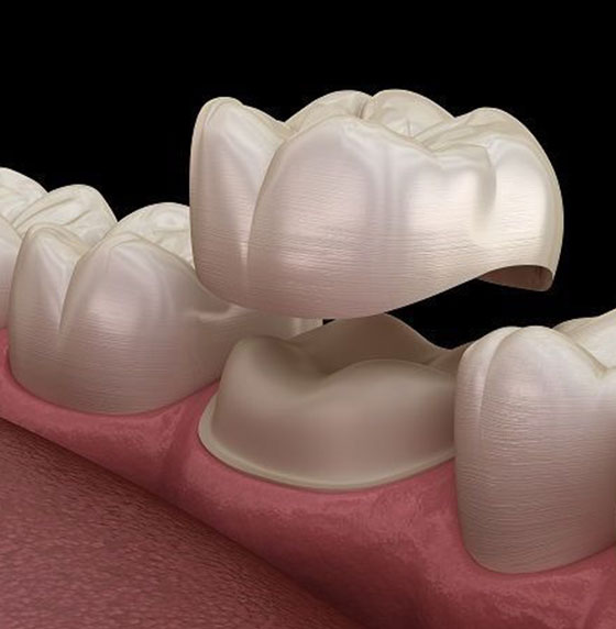 Same-Day Crowns