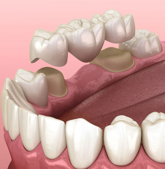 Dental Bridges