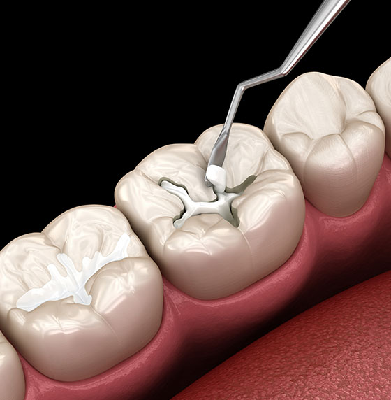 Composite Fillings