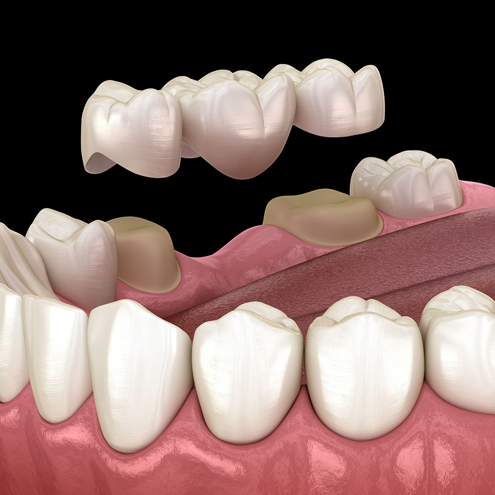 Dental Bridges