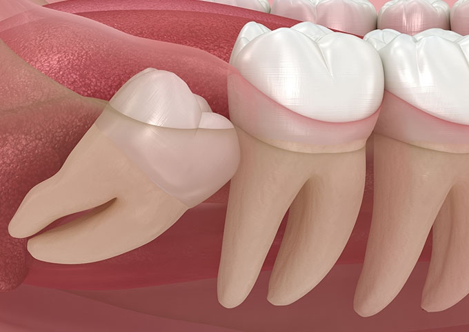 Wisdom Teeth Removal
