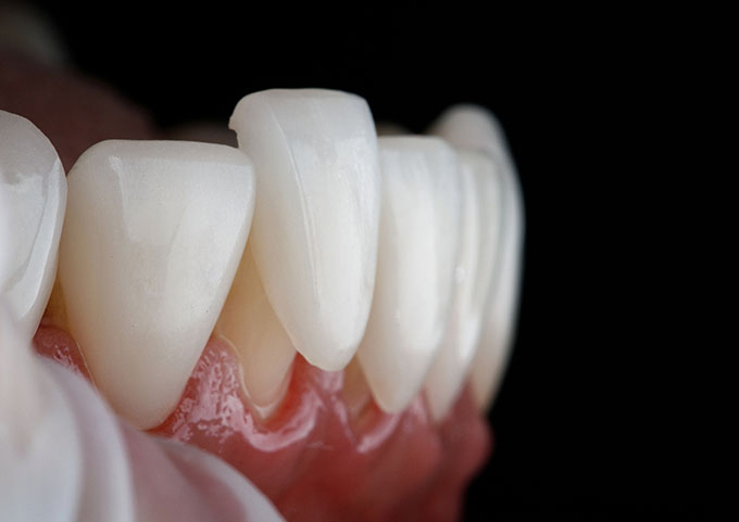Porcelain Veneers