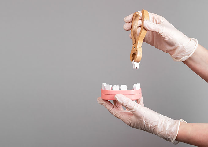 Tooth Extractions