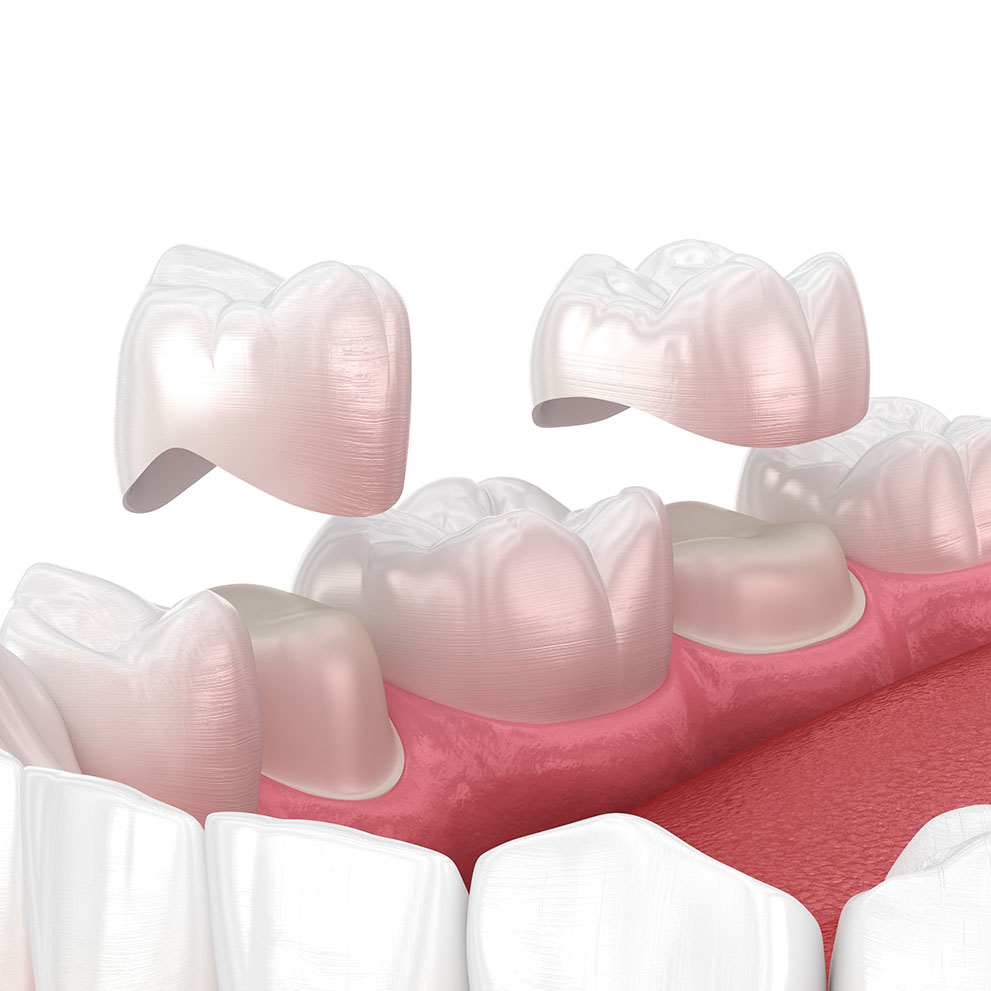 Same-Day Crowns