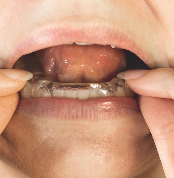 How Fairhope Patients Find Jaw Relief